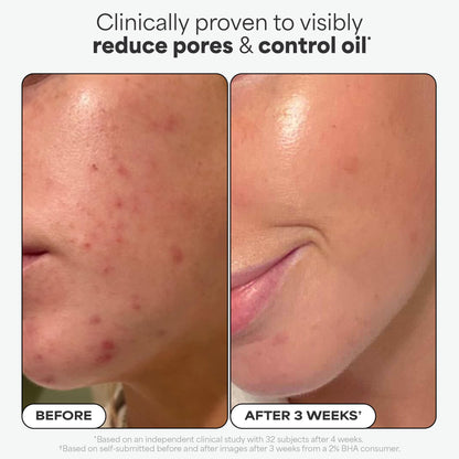 Paula's Choice Skin Perfecting 2% BHA Exfoliante Liquido - Peeling Facial Combate los Puntos Negros, Poros Dilatados, Espinillas y Acne - con Ácido Salicílico - Piel Mixta a Grasa - 118 ml